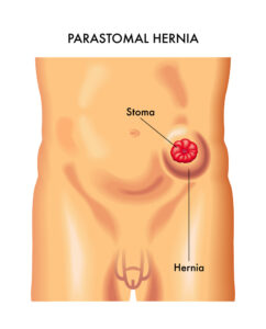 Intra-Abdominal Pressure Dangers